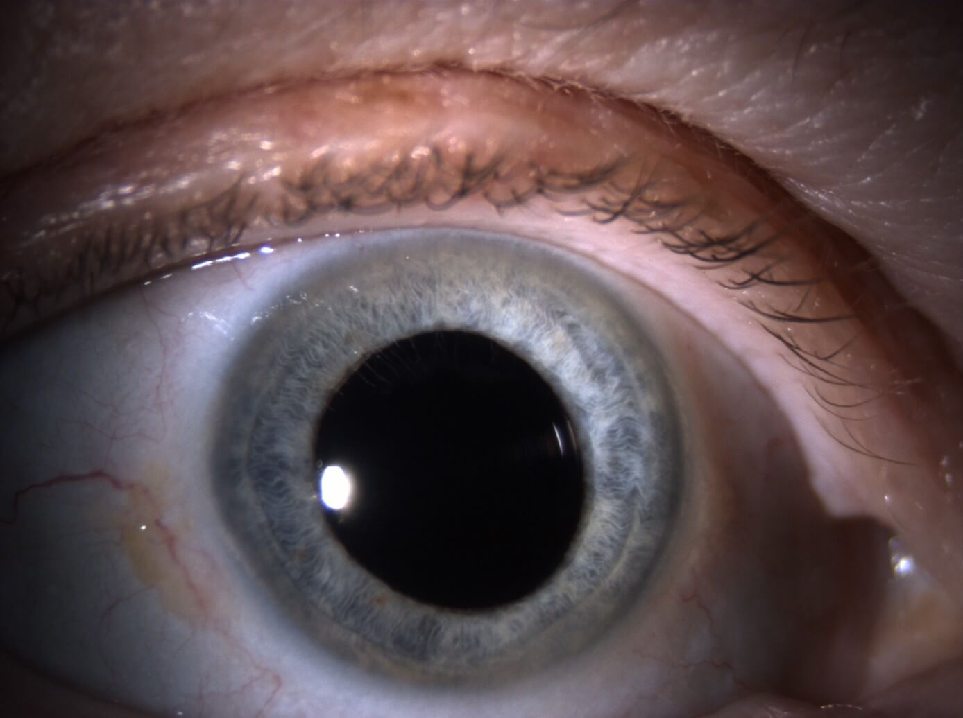 Patient looking straight ahead with lid lift; no collarettes are visible