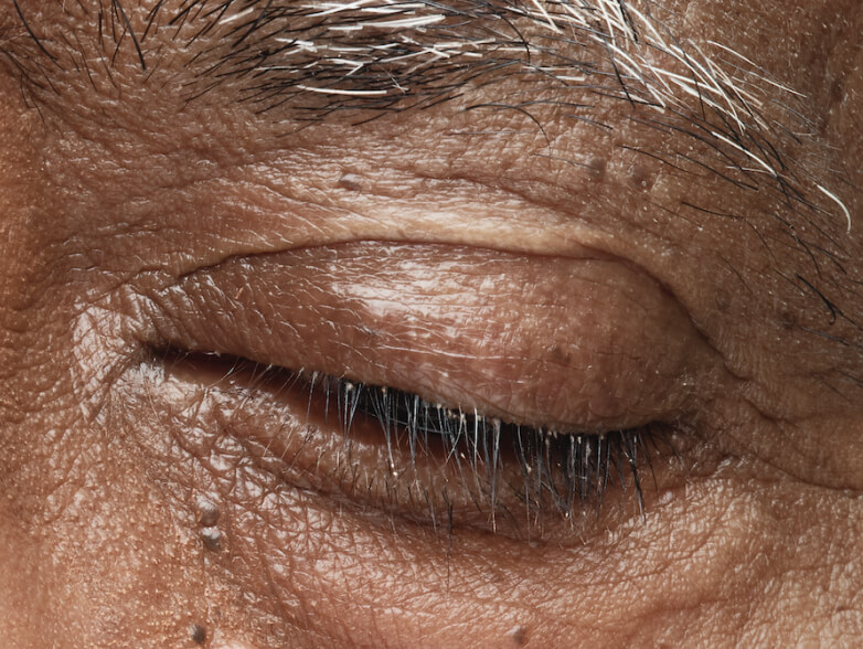Close up of a male patient's eye. Collarettes are visible.