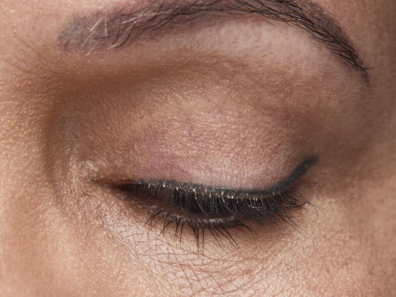 Close up of a female patient's eye. Collarettes are visible.