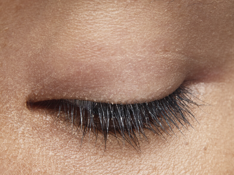 Close up of a female patient's eye. Collarettes are visible.