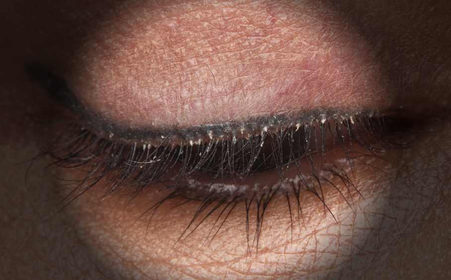 Patient looking down; collarettes are visible
