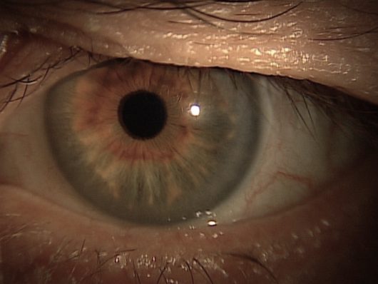 Patient looking straight ahead with lid lift; no collarettes are visible