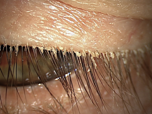 Patient looking down; collarettes are visible