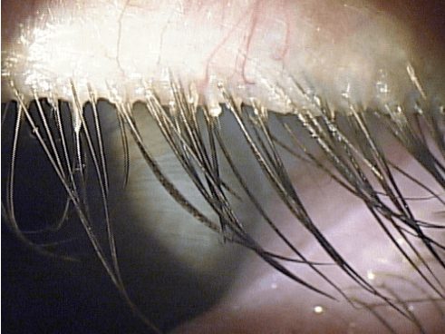 Patient looking down; collarettes are visible